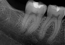 CMOS technology has made dental X-rays safer, cheaper and easier to process
